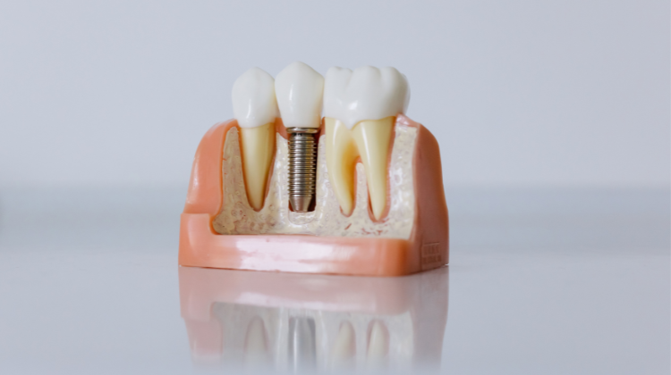 Featured image for “Your Complete Guide to Dental Implants in South Bend, IN”